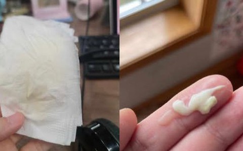 Những bức ảnh phát ra tiếng khóc thét: Nỗi ám ảnh mang tên TẮC TIA SỮA, ngoài sữa ra các mẹ còn có thể sản xuất được cả... phomai