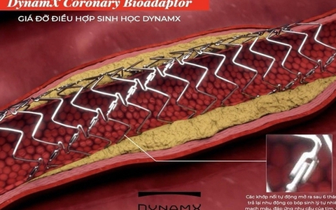 Stent tương thích sinh học thế hệ mới giảm biến chứng tim mạch