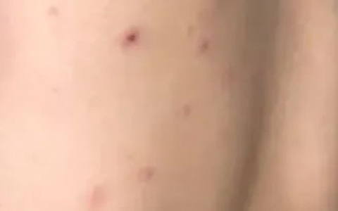 Cứu sống bé 10 tuổi bị thủy đậu biến chứng viêm não