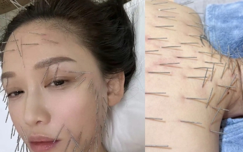 Sốc nặng hình ảnh Trần Kiều Ân cắm hàng trăm chiếc kim khắp cơ thể, làm đẹp mà chấp nhận đau đớn không tưởng!