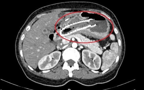 Bác sĩ Mỹ khuyên người phụ nữ về Việt Nam điều trị ung thư