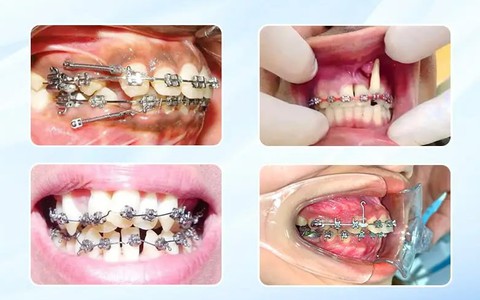 Niềng răng hỏng: Nguy cơ tiềm ẩn đằng sau lựa chọn "giá rẻ"