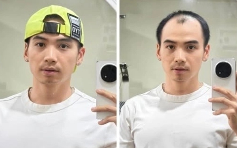 Chồng H'Hen Niê thay đổi thế nào sau cấy tóc trị hói đầu? Phương pháp này có giá bao nhiêu?