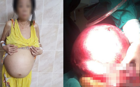 Cứu sống một phụ nữ mang khối u trong tử cung nặng đến…12kg