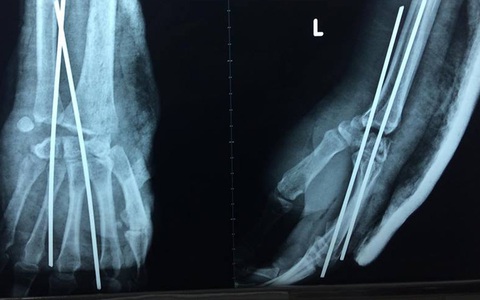Mâu thuẫn trong lúc nhậu, nam thanh niên bị chém đứt lìa tay