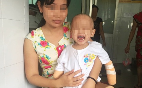 TP.HCM: Xót xa bé gái 2 tuổi bị đoạn tứ chi vì viêm não mô cầu