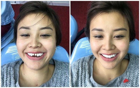 Mẹ bỉm 8X dũng cảm chịu đau, khoe hàm răng mài hẳn... 20 cái để ăn Tết cho xinh đẹp
