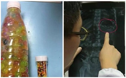 Nhầm hạt nhựa nở là kẹo, đôi vợ chồng Trung Quốc cho con gái 3 tuổi ăn hết gần... 300 viên