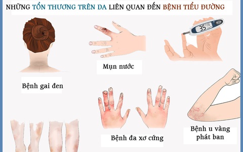 Những tổn thương trên da liên quan đến bệnh tiểu đường: Nhìn là nhận ra ngay