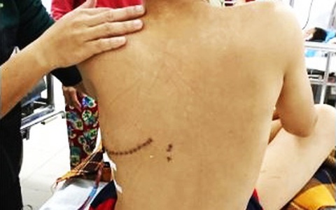Chọc ghẹo bạn, bé trai 14 tuổi bị phóng kéo vào lưng xuyên thấu ngực