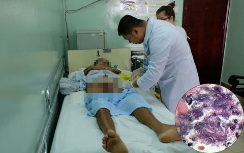 Hoại thư Fournier - căn bệnh nguy hiểm có thể gây hoại tử vùng kín ở cả nam và nữ giới