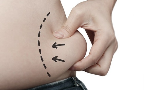 Hút mỡ giảm béo, người phụ nữ này đã suýt chết vì biến chứng hiếm gặp