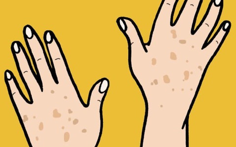 5 dấu hiệu da bị tổn thương do ánh mặt trời gây ra bạn không nên bỏ qua