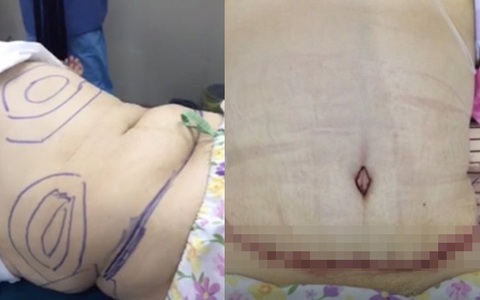 Phẫu thuật cắt bỏ mỡ bụng và những điều có thể chưa bao giờ biết