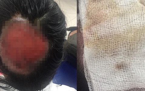Tai nạn nghiêm trọng khi uốn tóc: Tóc cuốn vào ống dẫn nhiệt, nữ bác sĩ bỏng sâu, tróc gần toàn bộ da đầu phía sau