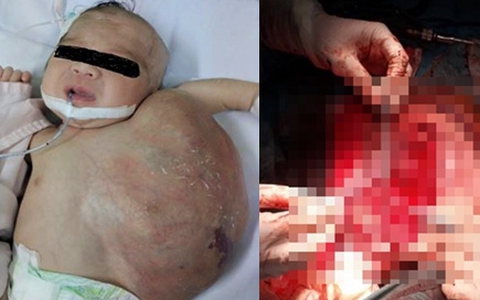 TP.HCM: Vừa chào đời, bé gái đã mang khối u khủng trên cơ thể khiến tính mạng nguy hiểm