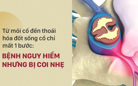 Căn bệnh nguy hiểm tấn công 82% người già và 60% thanh niên: Liệu bạn đã biết để tránh?