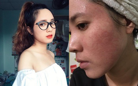 Bôi rượu thuốc bắc để "bong da tái tạo", cô gái trẻ bị nổi mụn chi chít, chảy dịch ngứa khắp mặt