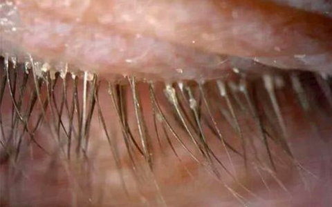 Rợn người hơn 100 con rận bám trên lông mi của người phụ nữ chỉ vì mắc phải thói quen nhiều người xem nhẹ