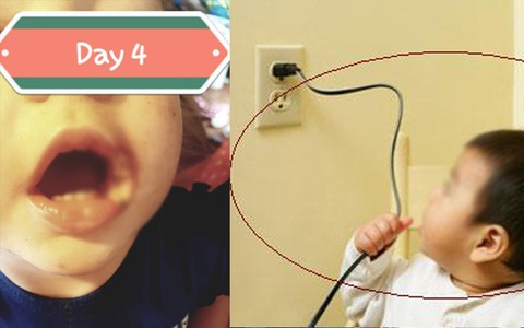 Bé gái 19 tháng tuổi bị phỏng điện suýt mất cả đôi môi vì thói quen vứt sạc điện thoại lung tung của bố mẹ