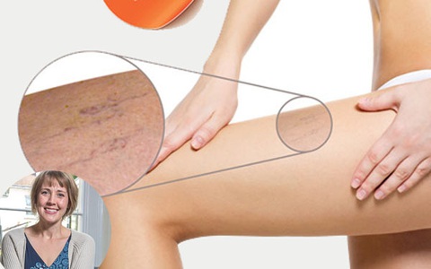 Đừng coi thường tĩnh mạch mạng nhện ở chân vì nó có thể là dấu hiệu cảnh báo nguy cơ loét chân