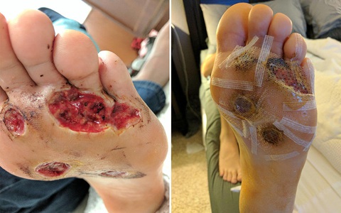 Đi tắm và không mang dép: Người đàn ông này đã bị vi khuẩn ăn thịt người tấn công