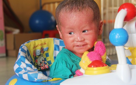 Bé Bích 20 tháng tuổi người đầy vẩy ngứa như da trăn nay đã biết đi, bi bô tập nói