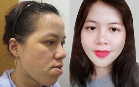 27 năm không khép được miệng và bị gọi là “đồ mặt méo”, cô gái tiến hành ca đại phẫu đổi diện mạo và kết quả không ngờ