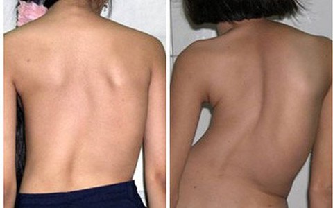 Phương pháp mới cứu bệnh nhân biến dạng cột sống thắt lưng thoát gù