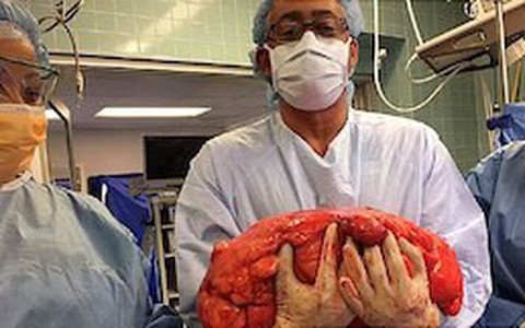 Ung thư tế bào mỡ: Những người có lớp mỡ bụng dày thật sự rất đáng lo ngại!