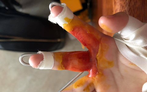 Bò chơi quanh nồi cơm điện, bé 1 tuổi bị bỏng hơi để lại sẹo co rút các ngón tay