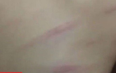 Vụ bé gái lớp 1 bị cô giáo đánh bầm lưng do lười học: Cô giáo bị sốc tâm lý nặng sau sự việc