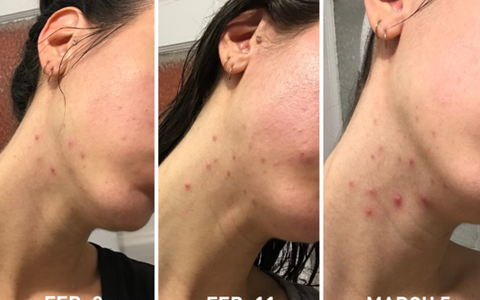 Nữ biên tập viên mảng làm đẹp này đã phải khổ sở mụn trên mặt do tránh thai và đây là cách cô đã làm để hết mụn