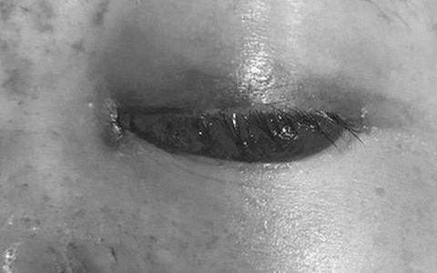 Chủ tiệm spa bị phạt tiền vì tiêm filler gây mù mắt