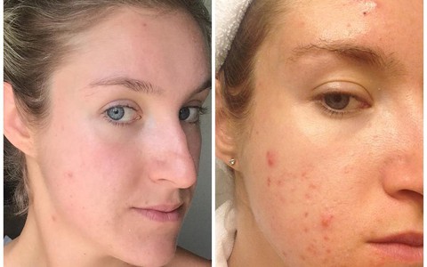 Dư thừa estrogen có thể gây ung thư ở phụ nữ và đây là 8 dấu hiệu nhận biết