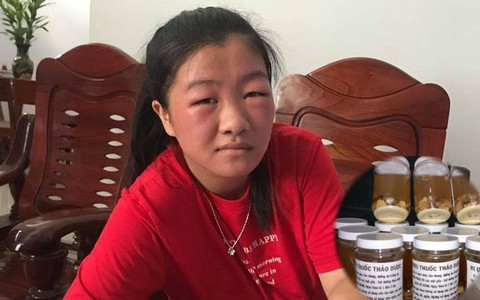 Cô gái sưng phù mặt vì bôi rượu thuốc lên mặt cho trắng: Khuyến cáo của chuyên gia không ai được bỏ qua!