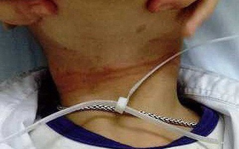 Bé trai 6 tuổi suýt chết vì bị dây nhựa thắt cổ