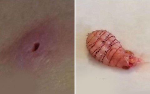 Thấy có nốt ngứa ở đùi, cô dâu mới ngã ngửa khi biết đó là tổ của một con giòi đang sống