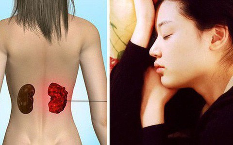 Ung thư thận: không can thiệp sớm thì chỉ sống được khoảng 1 năm và đây là 3 dấu hiệu nhận biết điển hình