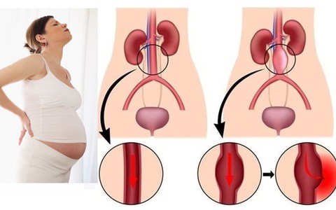 Có một hiện tượng trong thai kì có thể khiến máu lưu thông kém, gây nguy hiểm tới mẹ và bé