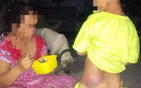 Vụ bé trai tật nguyền bị cô giáo đánh bầm tím người: Cô giáo đến nhà xin lỗi