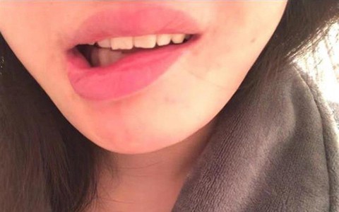 Bỏ hơn 100 triệu đi trùng tu nhan sắc, cô gái trẻ khóc ròng khi nhận về cái miệng lệch, sợ không lấy được chồng vì di chứng thẩm mỹ