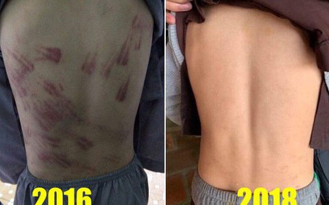 Thông tin bất ngờ vụ việc bé trai bị sư thầy đánh tím bầm cơ thể