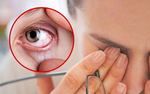 Đừng xem thường tình trạng khô mắt vì biến chứng rất nghiêm trọng và đây là cách để nhận biết
