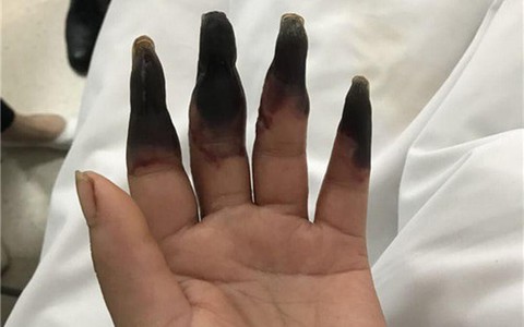 Dọn nhà, người phụ nữ bị hoại tử 8 ngón tay đen sì: Triệu chứng bất thường mọi người phải hết sức cảnh giác