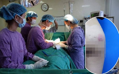 Cô gái 25 tuổi bị nhiễm trùng vì tự bơm silicon vào mông tại nhà: Khuyến báo không thừa của bác sĩ 