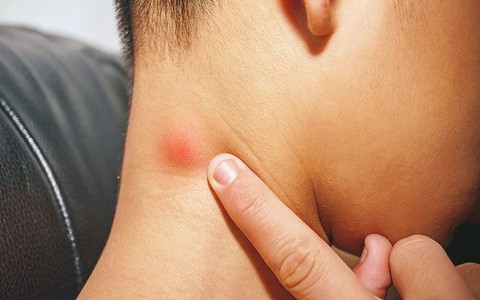 Nếu bỗng nhiên thấy sưng hoặc nổi cục ở cổ và tai, đừng bao giờ bỏ qua những khả năng này