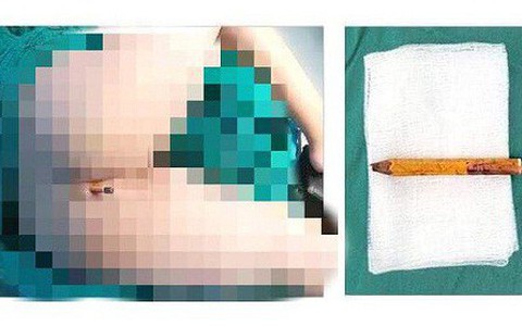 Hy hữu: Bé trai bị bút chì đâm xuyên vào mông