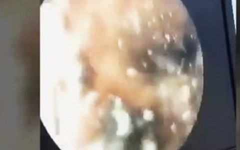 Long An: Bé gái 4 tháng tuổi bị giòi làm tổ, ăn chảy máu lỗ tai