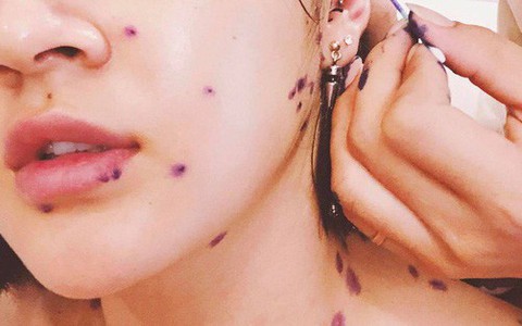 Mùa hè đến rồi, cẩn thận không mắc bệnh thủy đậu giống như Bảo Anh